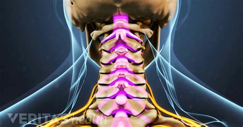 How Cervical Stenosis With Myelopathy Affects Your Body