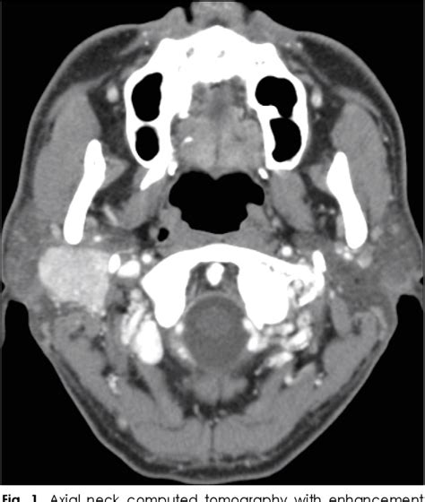 Figure 1 From Solitary Parotid Gland Metastasis From Renal Cell