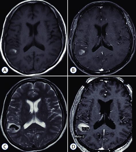 Radiosurgical Targeting Technique For Metastatic Brain Tumor With