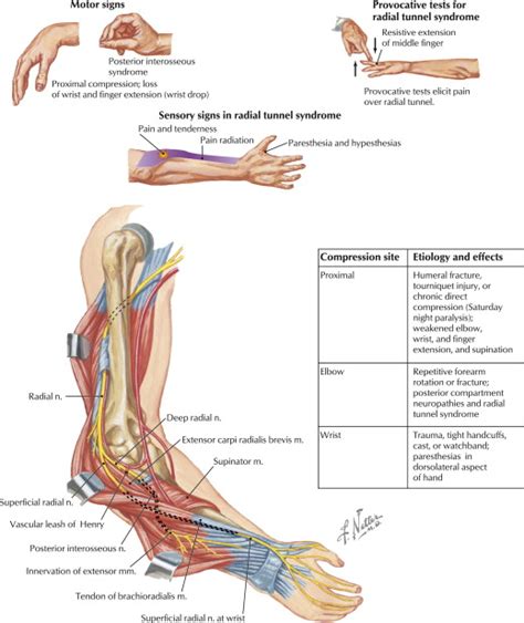 Diagnosis And Treatment Of Work Related Ulnar Neuropathy At The Elbow