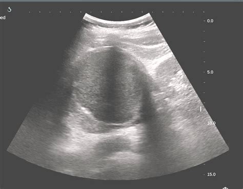 Vietnamese Medic Ultrasound Case 373 Pheochromocytoma Dr Phan Thanh