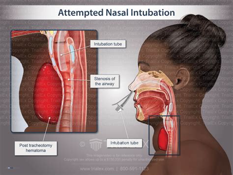 Attempted Nasal Intubation Trial Exhibits Inc
