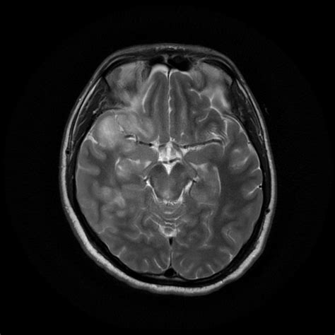 Diffuse Axonal Injury Dai Image