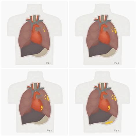 Proposals for revisions of the t descriptors in the forthcoming eighth edition of the tnm classification for pleural mesothelioma. The Importance of Proper Staging for Mesothelioma ...