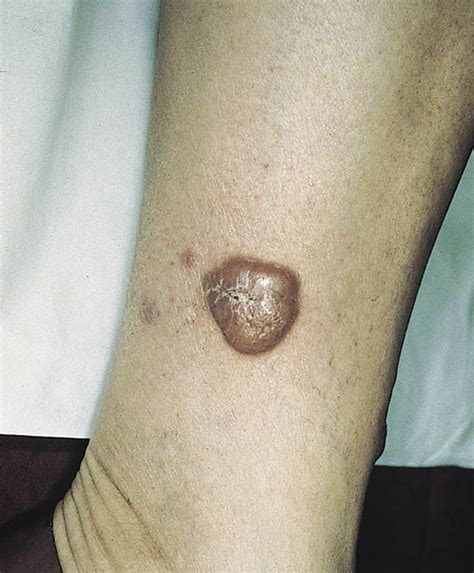 Primary Cutaneous Large B Cell Lymphoma Of The Leg Relapsing As