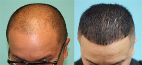 Side effects are rare, but they can occur. Hair Loss and Hair Thinning Treatments | Propecia ...