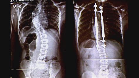 The Use Of Titanium Inserted Rods For Scoliosis Brandon Orthopedics