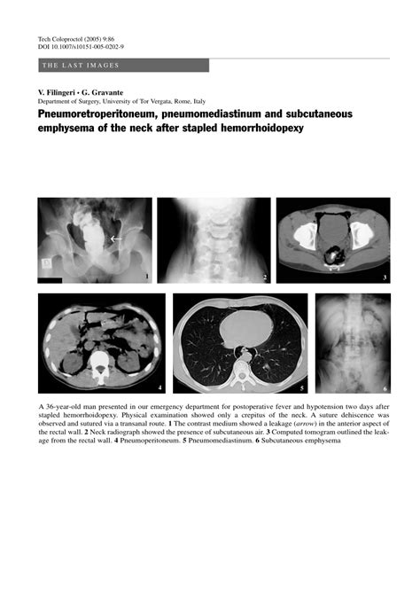 Pdf Pneumoretroperitoneum Pneumomediastinum And Subcutaneous Emphysema Of The Neck After