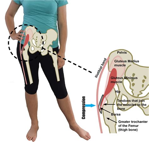 What Is Gluteal Tendinopathy Hip Bursitis Differences Causes