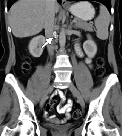 Coronal Contrast Enhanced Ct Image In A Patient With Ovarian Cancer