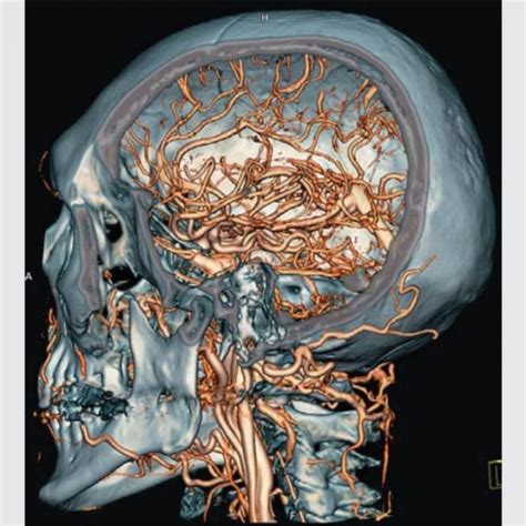 Computed Tomography Angiography Cta Charter Radiology
