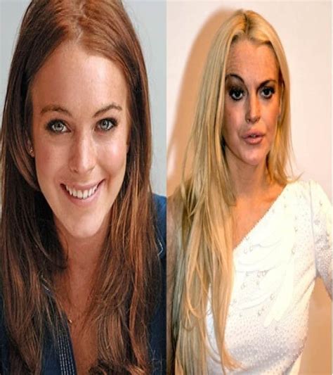 See Before And After Photos Of Celebrities Who Underwent Plastic Surgery Vrogue