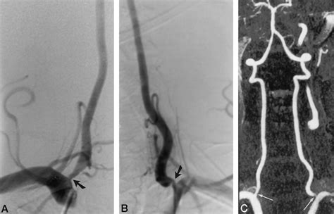 A And B Selective Conventional Angiograms Of The Right A And Left