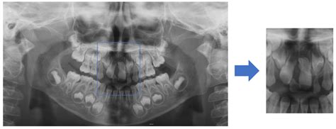 Diagnostics Free Full Text Automated Mesiodens Classification