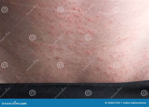 Rash On The Skin Of A Man In The Groin Area The Concept Of Venereal