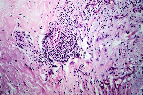 Breast Fibroadenosis Light Micrograph Stock Photo Image Of