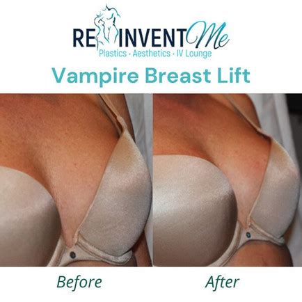 Vampire Breast Lift ReinventMe The Villages