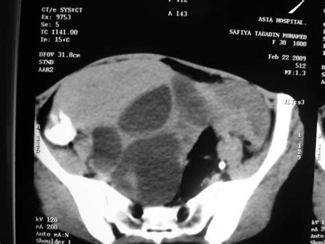 Theca Lutein Cysts In A 36 Years Old Patient With Past History Of A