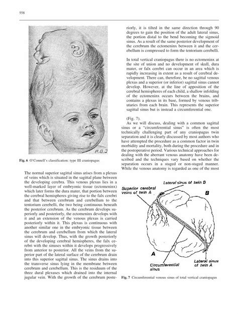 Pdf Craniopagus Twins Embryology Classification Surgical Anatomy