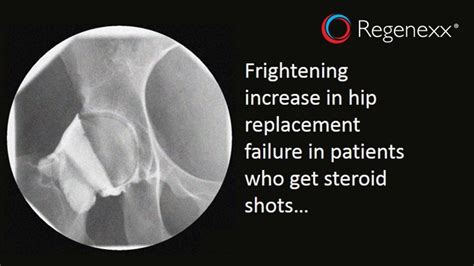 Hip Arthritis Steroid Shots Should Be Avoided Regenexx®