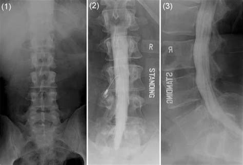 Myelography Myelogram