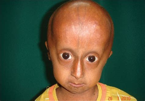 Hutchinson Gilford Progeria Syndrome Body