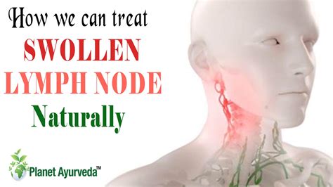 Swollen Lymph Nodes Throat