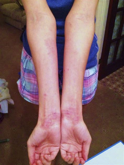 Girl Bullied Over Severe Eczema So Bad She Was Called Snake Skin