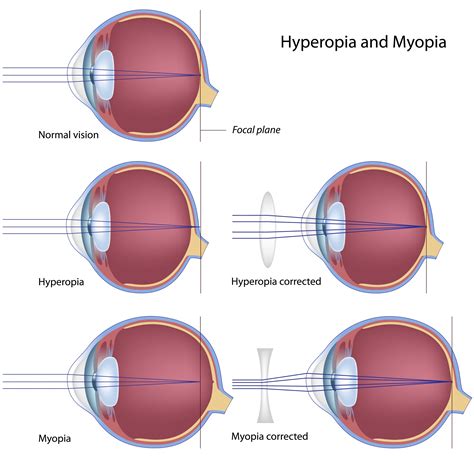 Nearsighted Petrou Eye Care