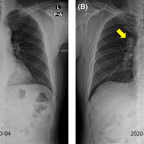 A Right Hilar Mass Arrow Partially Obscured By The Right Pulmonary