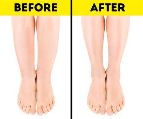 Why You Have Cankles And Tips To Help You Deal With Them Bright Side