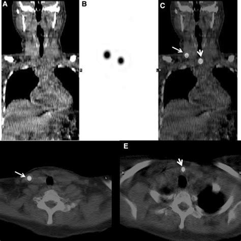 Spect Ct Imaging Of Metastatic Lymph Nodes Labeled With Roll Technique