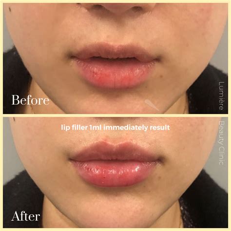 Lip Injections And Fillers Sydney Lumiere Clinic