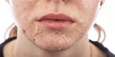 Skin Rashes Associated With Covid 19 Coronavirus
