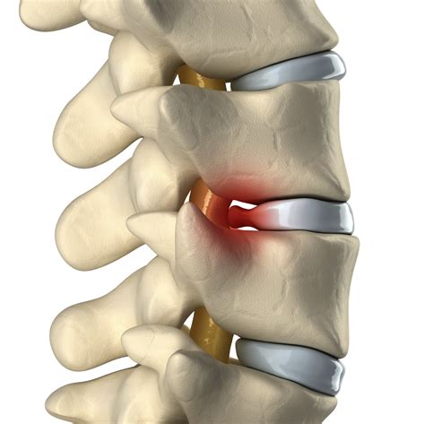 Hernia De Disco No Pescoço Sintomas