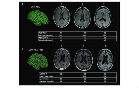 Representative Examples Of Diffuse Cortical Atrophy In Mri Scans Of