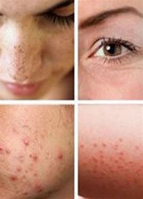 Types Of Skin Allergy Quickhomeremedy