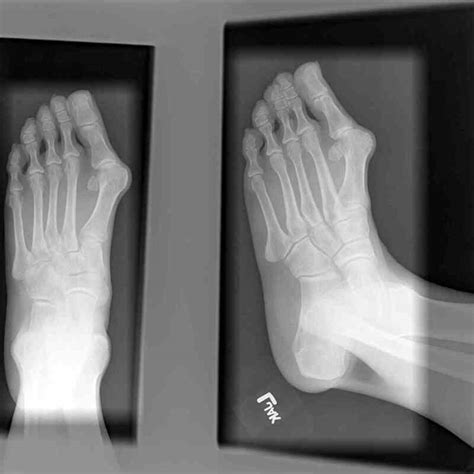 Figure Foot Radiograph Hallux Valgus Contributed By Scott Dulebohn