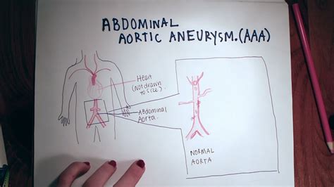 Abdominal Aortic Aneurysm Youtube