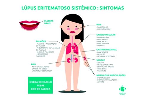 Lúpus Saiba O Que é E Como Identificar A Doença Fernandópolissp