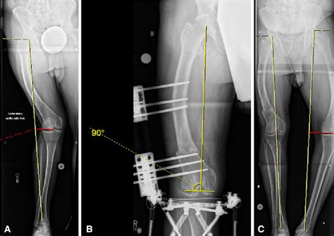 Pdf Distal Femoral Osteotomy Is Internal Fixation Better Than