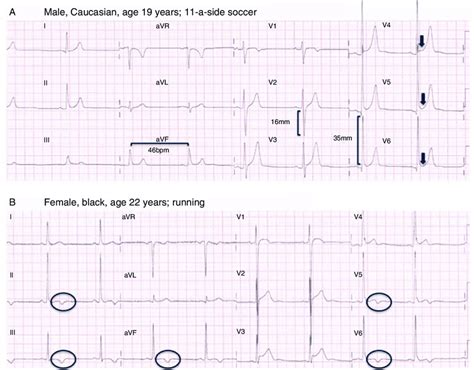 Two Of The Electrocardiograms Ecgs In The Study Questionnaire A