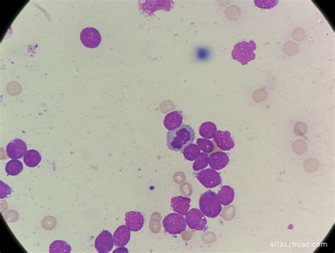 Leucemia Aguda Linfoblástica Laboatlas