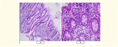 Histopathology Of The Duodenal And Ileal Biopsies A Fragment Of