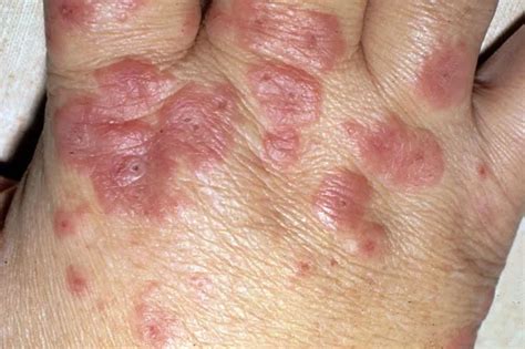 Pictures Of Skin Diseases And Problems Erythema Multiforme 2