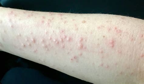 Red Skin Rash On Arm