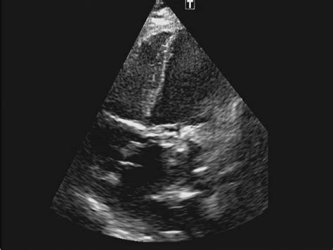 Transthoracic Echocardiography Mitral Prosthesis Thrombosis