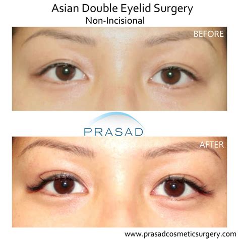 Double Eyelid Surgery Asian Eyelid Surgery In New York