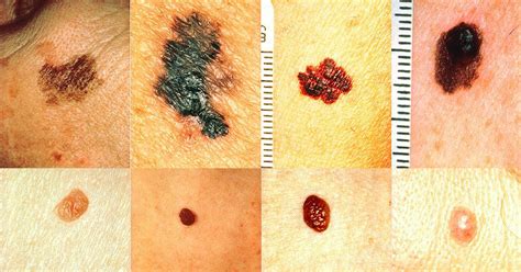 How To Recognize Skin Cancer This Could Save Your Life Herbs Health