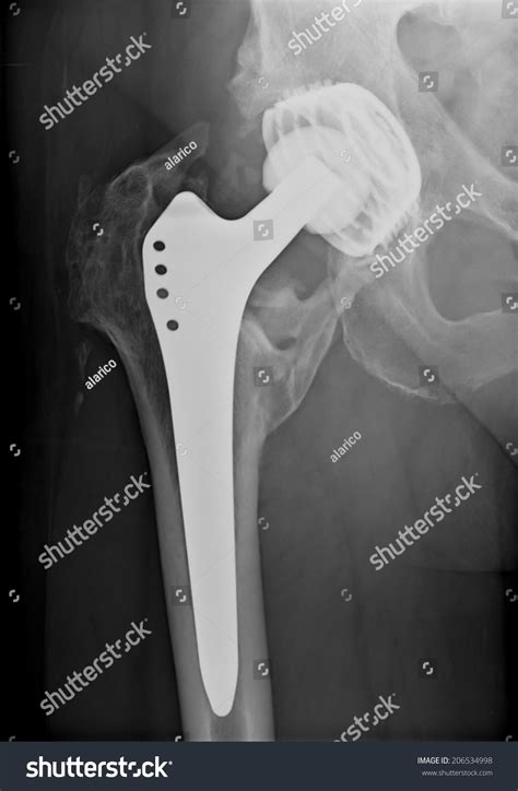 Xray Imaging Permanent Total Hip Arthroplasty Stock Photo 206534998